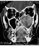 Image result for Sinonasal Tumors