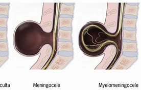 Image result for Spina Bifida Myelomeningocele Pics