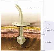 Image result for T Fasteners G-tube