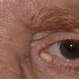 Image result for Inclusion Cyst Eyelid
