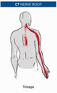 Image result for C6 Nerve Root Pain