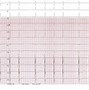 Image result for 2nd Degree Heart Block Type 1 vs 2