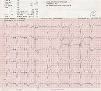 Image result for Abnormal ECG Rhythm Strips