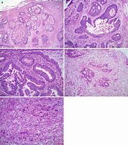 Image result for Ovarian Cancer Metastasis