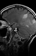 Image result for Neurosyphilis