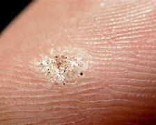 Image result for Molluscum or Warts