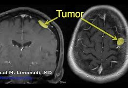 Image result for Meningioma Tumor Surgery Plates Screws