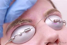 Image result for Eyebrow Tattoo Removal