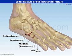 Image result for Jones Fracture