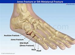 Image result for Fifth Metatarsal Stress Fracture