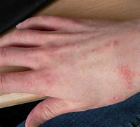 Image result for Scabies On Scalp