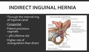 Image result for Igual Hernia