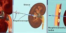 Image result for Ureteral Stent vs Nephrostomy Tube