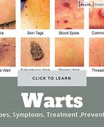 Image result for Different Kinds of Warts
