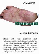 Image result for Chancroid Diagram
