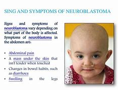 neuroblastoma 的图像结果