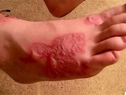 Image result for HPV Virus On Feet