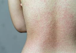 Image result for Skin Allergic Reaction