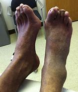 Image result for Scabies On Ankles