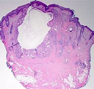 Image result for Sebaceous Cyst Histology