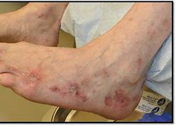 Image result for Vasculitis On Feet