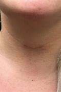 Image result for Thyroid Removal Scar