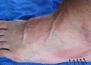 Image result for Metatarsal Bruise