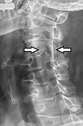 Image result for Back Braces for Spinal Stenosis
