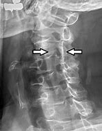 Image result for Back Brace for Spinal Stenosis