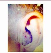 Image result for Squamous Papilloma Ear Canal