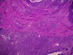 Image result for Squamous Papilloma Skin
