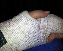 Image result for Double Arm Cast