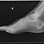 Image result for OS Peroneum Feet