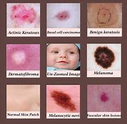 Image result for Human Skin Diseases