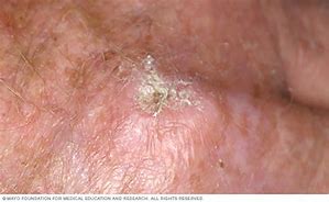 Image result for Actinic Keratosis Back