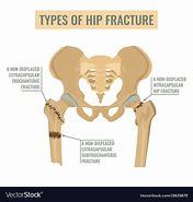 Image result for Hip Fracture Cartoon