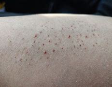 Image result for Trypophobia Skin Disease