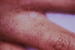 Image result for Scabies Rash On Skin
