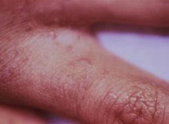 Image result for Scabies Linear