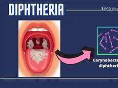 Image result for diphteria