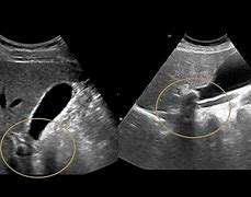 Image result for Liver and Gallbladder Ultrasound