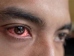 Image result for Covid Eyes Symptom