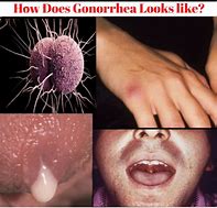 Image result for Gonorrhea Signs Woman