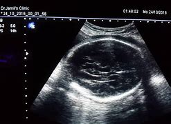 Image result for Hydrocephalus in Utero