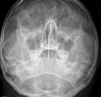 Image result for Cuboid Bone Fracture