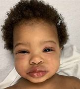 Image result for Allergie Baby Symptome