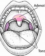 Image result for Where Are Tonsils and Adenoids Located