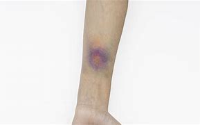 Image result for How to Make Fake Bruises with Makeup
