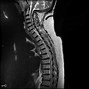 Image result for Cervical Spine Pinched Nerve Symptoms