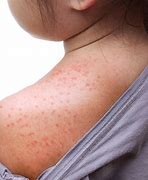 Image result for Common Skin Rashes Itchy